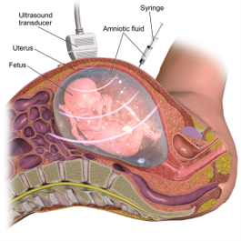 A drawing showing the process of amniocentesis, as described in the text above