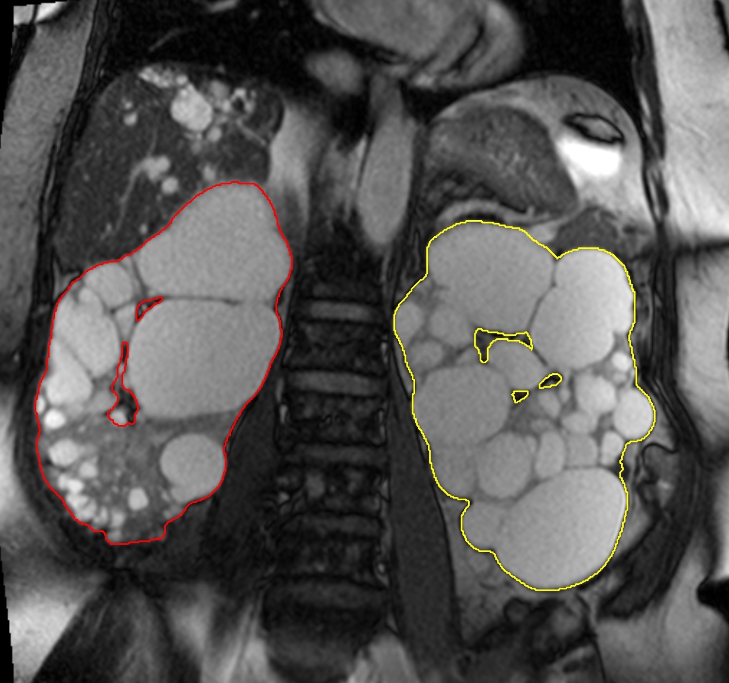 MRI image of abdomen