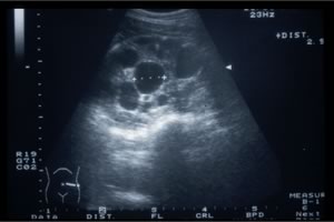 Ultrasound picture of a kidney with multiple cysts