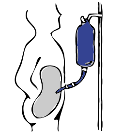 Peritoneal dialysis