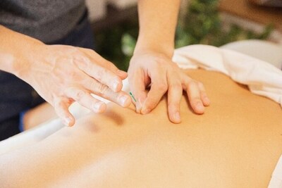 A person having acupuncture on their back.