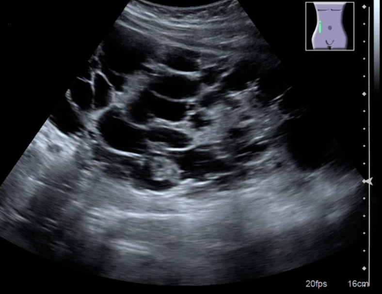[Alt text: An ultrasound image of a PKD kidney. Much of the screen is black. Where the ultrasound waves hit body tissue, the scan appears grey or white. The cysts appear as black circles].