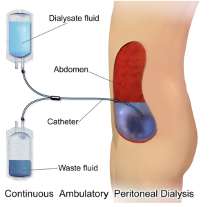 Diagram showing peritoneal dialysis. An empty bag connected to the catheter is used to drain fluid out the abdomen. A bag of fresh fluid is connected to a catheter to refill the abdomen.
