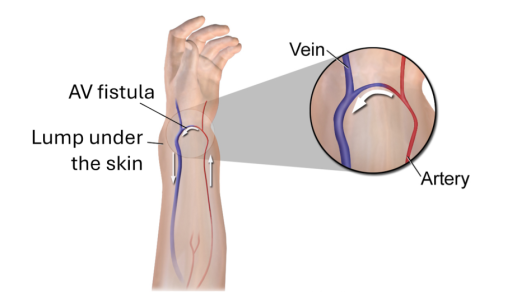 Diagram showing an AV fistula. A vein and artery are shown running down the lower arm. The two vessels are joined so that blood can flow between them.