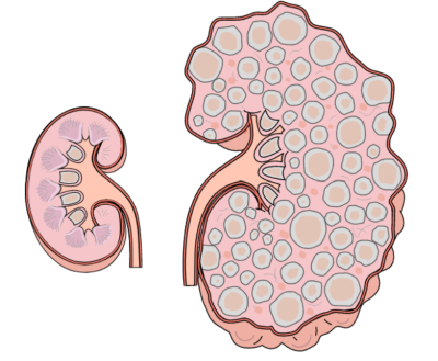 A picture of a normal kidney compared with an ADPKD kidney. The ADPKD kidney is much larger and has many cysts of varying size.