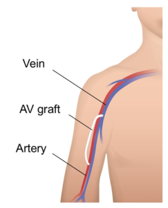  Diagram showing an AV graft. A vein and artery are shown running down the upper arm. The two vessels are joined by a tube under the skin.