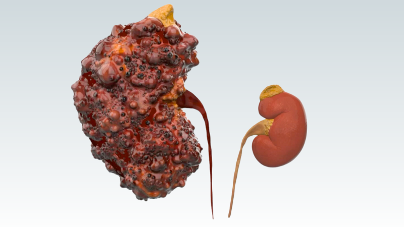 New Hope for PKD Patients: IMPEDE-PKD Research Study